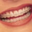 Ceramic Braces