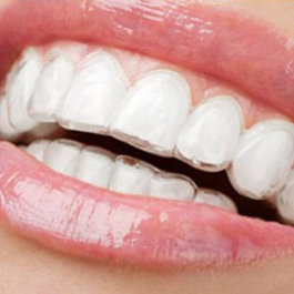 Invisalign Braces