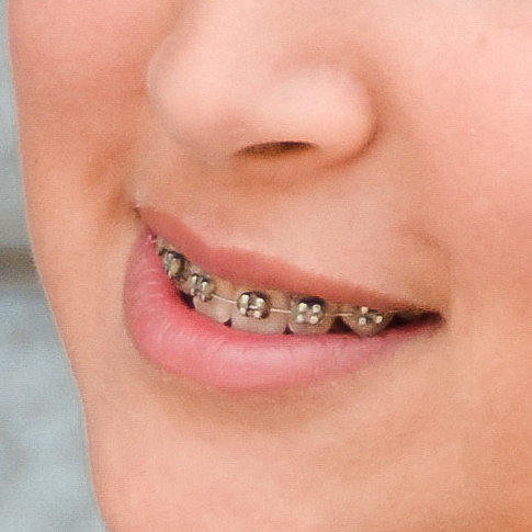 Traditional Metal Braces